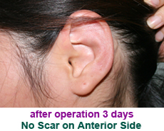 plastic-surgery-prominent-ear 